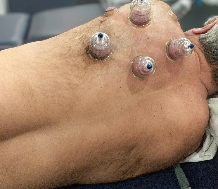 lynchburg physical therapy cupping