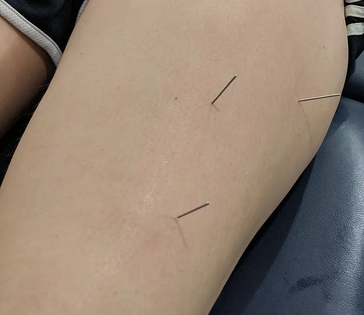 lynchburg physical therapy dry needling